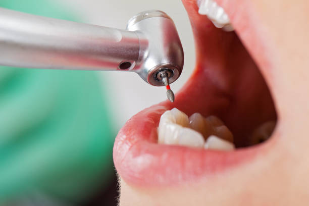 Best Emergency Dentist for Lost Fillings or Crowns in Brazoria, TX